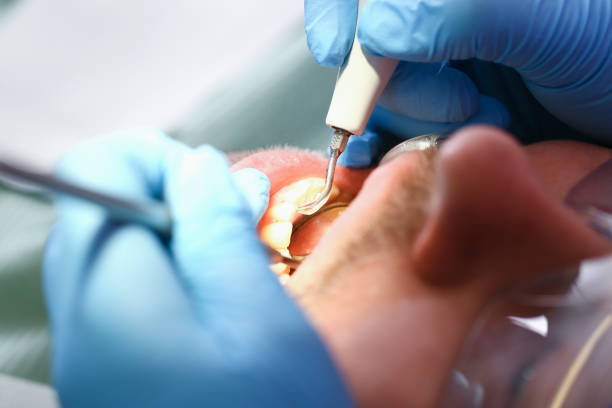 Best Emergency Tooth Extraction in Saint Johns University, MN